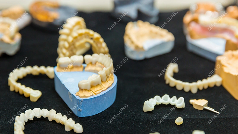 Temporary Veneers